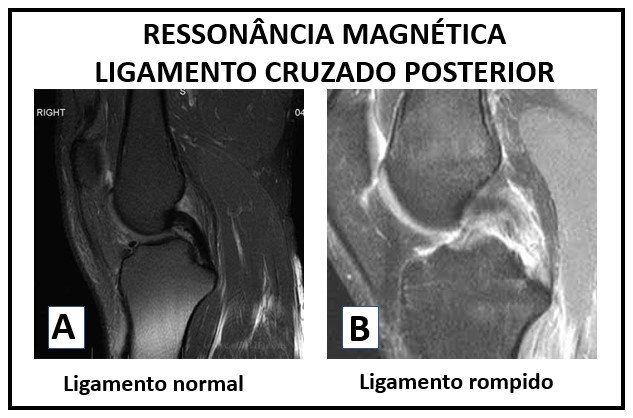 Les Es Do Ligamento Cruzado Posterior Lcp Dr Jo O Hollanda