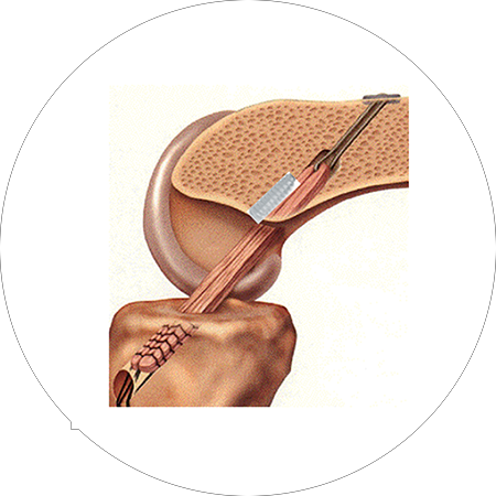 Métodos de Fixação na Cirurgia de Reconstrução do Ligamento Cruzado Anterior
