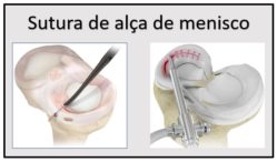 Lesão Em Alça De Balde Do Menisco Dr João Hollanda 