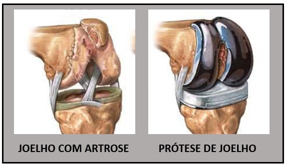 protese de joelho